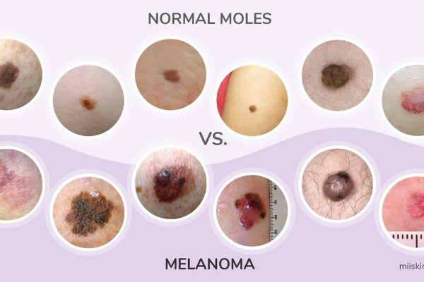 MOLE OR SKIN BLEMISH? GET IT CHECKED APPOINTMENTS AVAILABLE AND DROP-IN CLINIC at Northgate Medical Practice on TUESDAY MAY 14TH 2024 FROM 8.30 AM TO 12.30